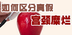 宫颈糜烂：假性糜烂和真性糜烂